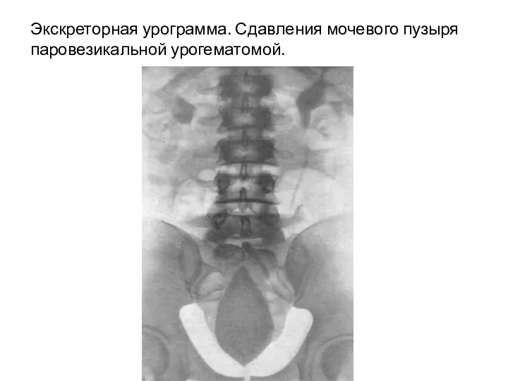 Экскреторная урограмма. Сдавления мочевого пузыря паровезикальной урогематомой.