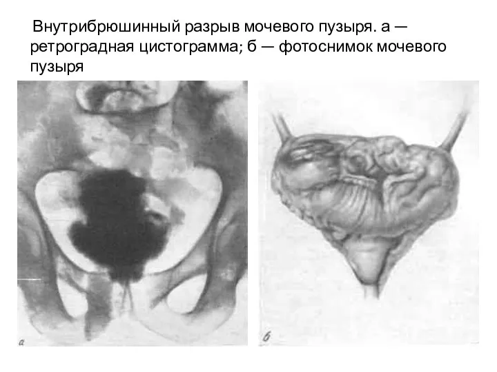 Внутрибрюшинный разрыв мочевого пузыря. а — ретроградная цистограмма; б — фотоснимок мочевого пузыря