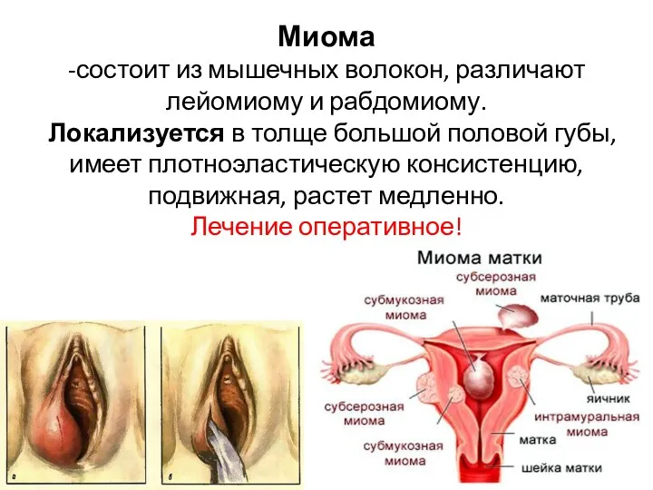 Миома -состоит из мышечных волокон, различают лейомиому и рабдомиому. Локализуется