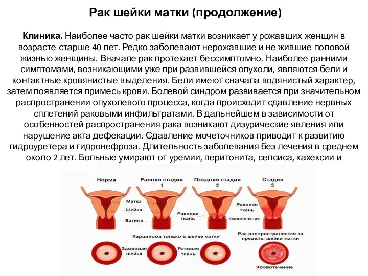 Рак шейки матки (продолжение) Клиника. Наиболее часто рак шейки матки