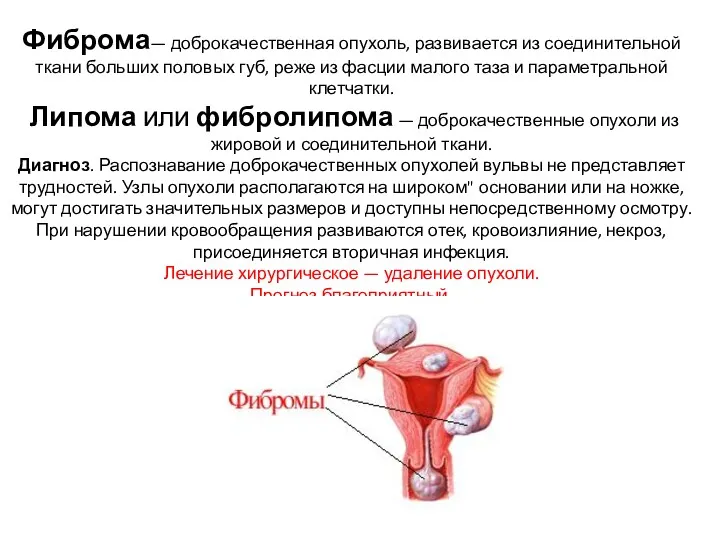 Фиброма— доброкачественная опухоль, развивается из соединительной ткани больших половых губ,