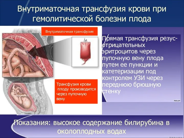 Внутриматочная трансфузия крови при гемолитической болезни плода Прямая трансфузия резус-отрицательных