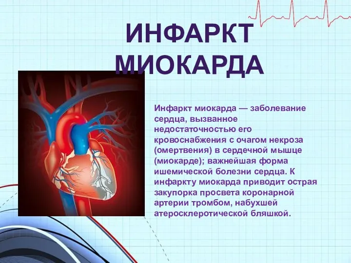 Инфаркт миокарда — заболевание сердца, вызванное недостаточностью его кровоснабжения с очагом некроза (омертвения)