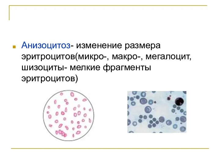 Анизоцитоз- изменение размера эритроцитов(микро-, макро-, мегалоцит, шизоциты- мелкие фрагменты эритроцитов)