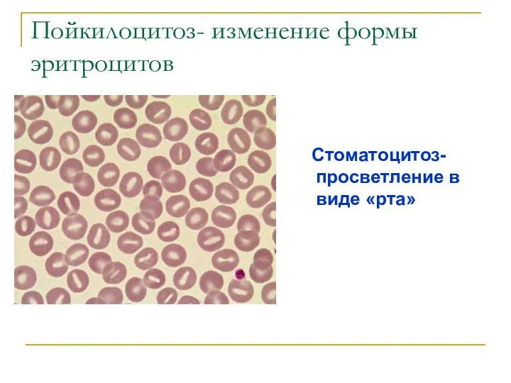 Пойкилоцитоз- изменение формы эритроцитов Стоматоцитоз- просветление в виде «рта»