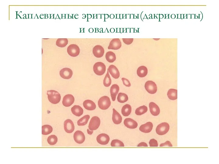 Каплевидные эритроциты(дакриоциты) и овалоциты