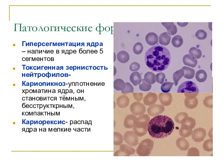 Патологические формы нейтрофилов Гиперсегментация ядра – наличие в ядре более 5 сегментов Токсигенная