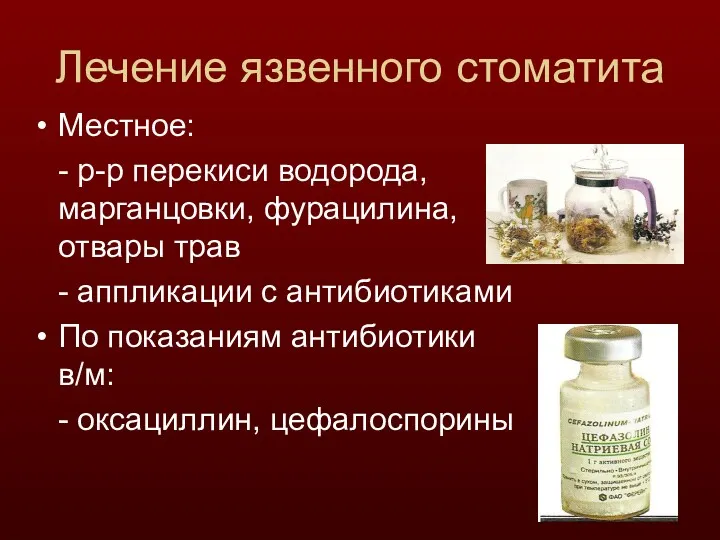 Лечение язвенного стоматита Местное: - р-р перекиси водорода, марганцовки, фурацилина,