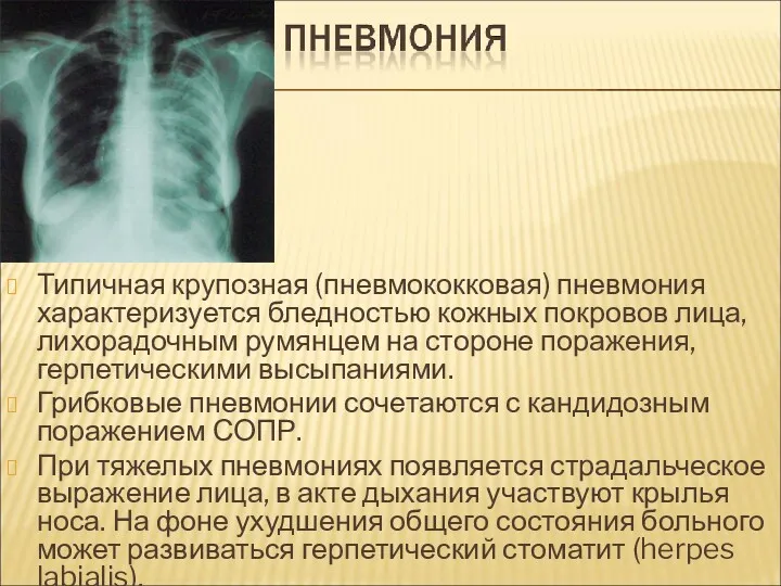 Типичная крупозная (пневмококковая) пневмония характеризуется бледностью кожных покровов лица, лихорадочным