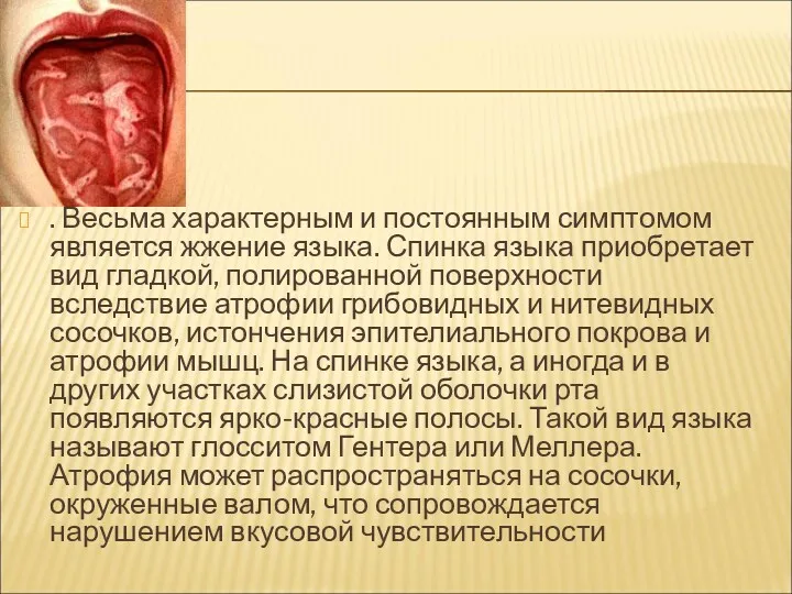 . Весьма характерным и постоянным симптомом является жжение языка. Спинка