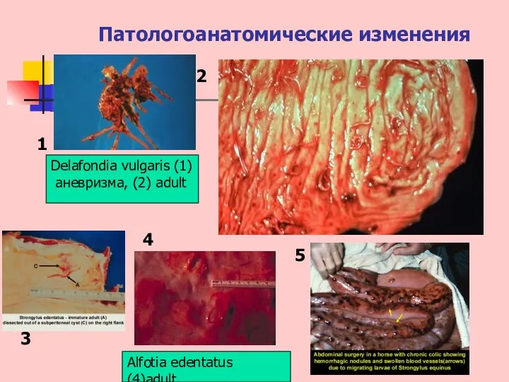 Патологоанатомические изменения 1 2 3 4 5 Delafondia vulgaris (1) аневризма, (2) adult Alfotia edentatus (4)adult