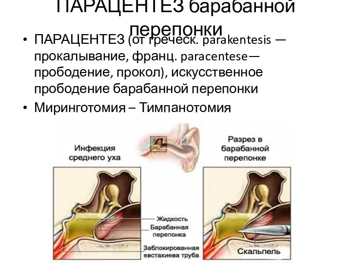 ПАРАЦЕНТЕЗ барабанной перепонки ПАРАЦЕНТЕЗ (от греческ. parakentesis — прокалывание, франц.