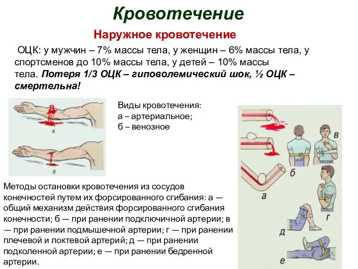 Кровотечение Виды кровотечения: а – артериальное; б – венозное Методы