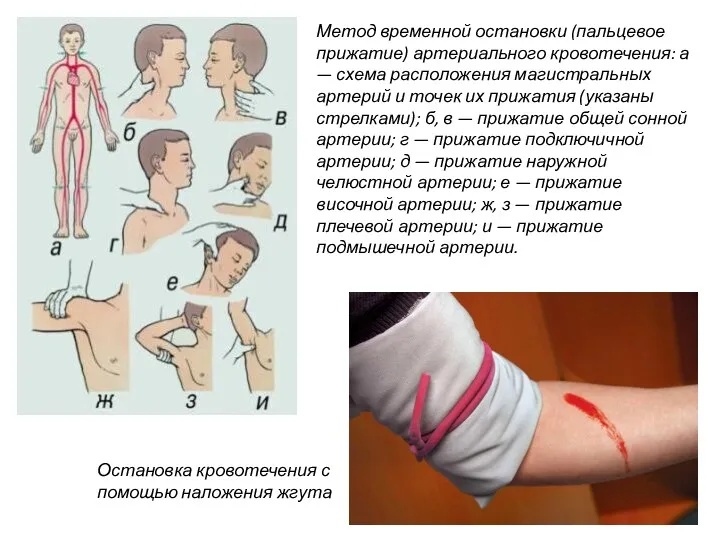 артерии; и — прижатие подмышечной артерии. Метод временной остановки (пальцевое