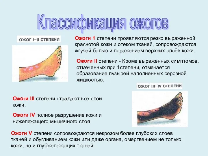 Ожоги 1 степени проявляются резко выраженной краснотой кожи и отеком