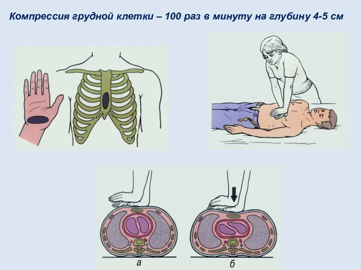 Компрессия грудной клетки – 100 раз в минуту на глубину 4-5 см