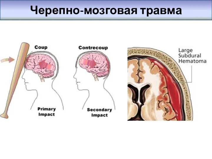 Черепно-мозговая травма