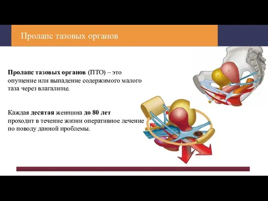 Пролапс тазовых органов Пролапс тазовых органов (ПТО) – это опущение