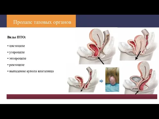 Пролапс тазовых органов Виды ПТО: • цистоцеле • утероцеле •