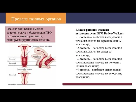 Пролапс тазовых органов Практически всегда имеется сочетание двух и более