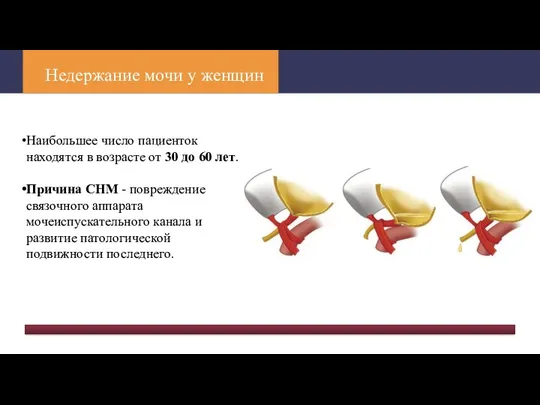 Недержание мочи у женщин Наибольшее число пациенток находятся в возрасте