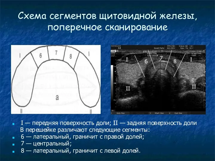 Cхема сегментов щитовидной железы, поперечное сканирование I — передняя поверхность