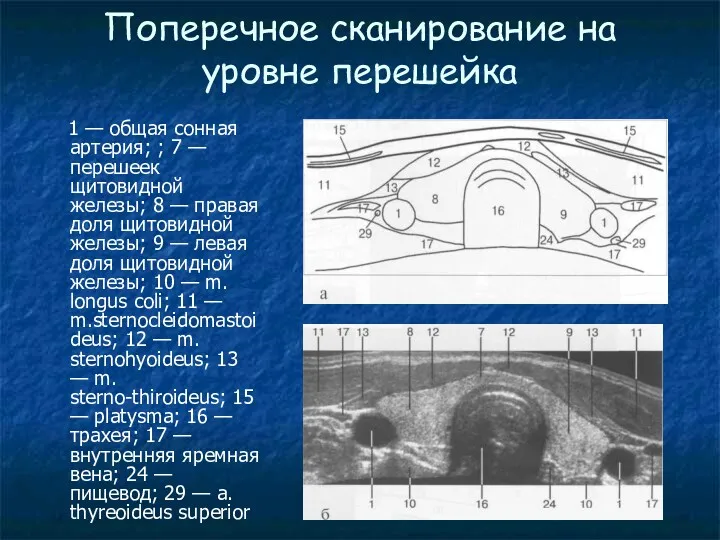 Поперечное сканирование на уровне перешейка 1 — общая сонная артерия;