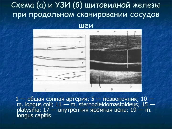 Схема (а) и УЗИ (б) щитовидной железы при продольном сканировании