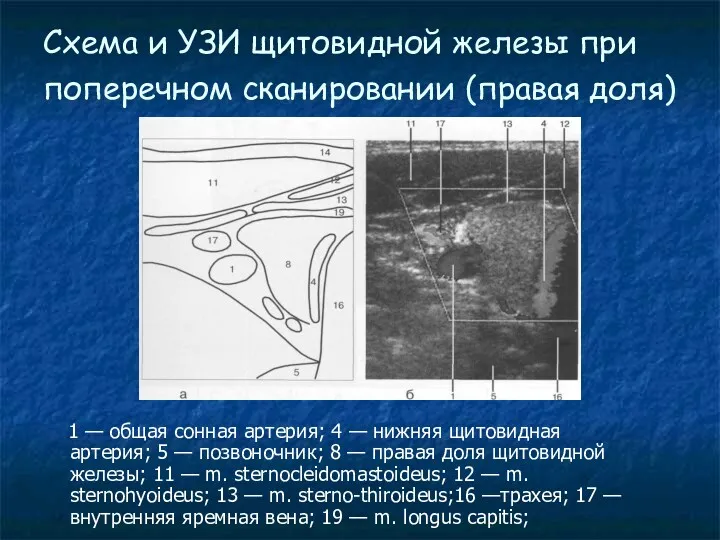 Схема и УЗИ щитовидной железы при поперечном сканировании (правая доля)