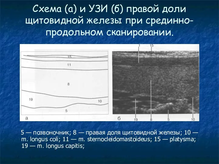 Схема (а) и УЗИ (б) правой доли щитовидной железы при