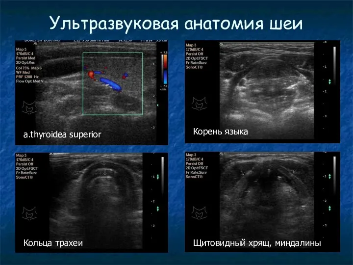 Ультразвуковая анатомия шеи a.thyroidea superior Корень языка Кольца трахеи Щитовидный хрящ, миндалины