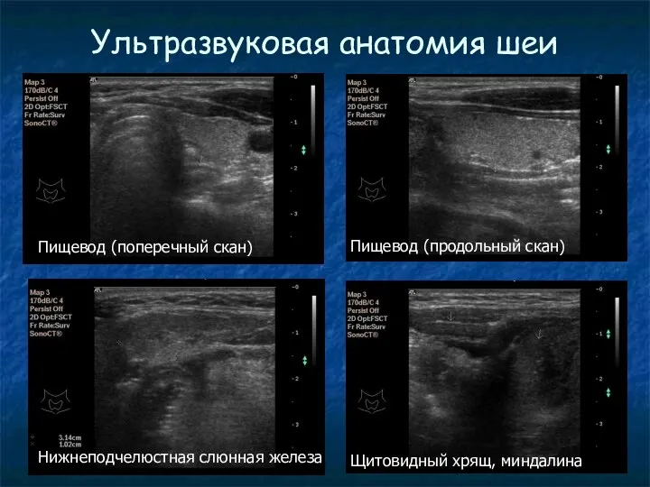 Ультразвуковая анатомия шеи Пищевод (поперечный скан) Пищевод (продольный скан) Нижнеподчелюстная слюнная железа Щитовидный хрящ, миндалина