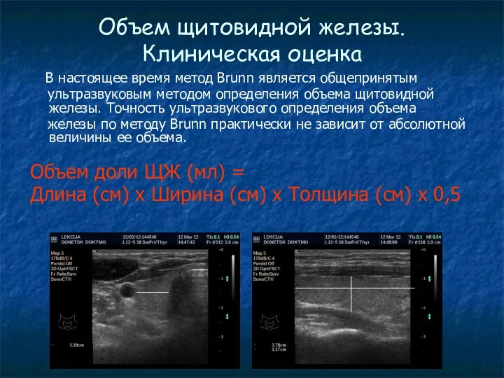 Объем щитовидной железы. Клиническая оценка В настоящее время метод Brunn