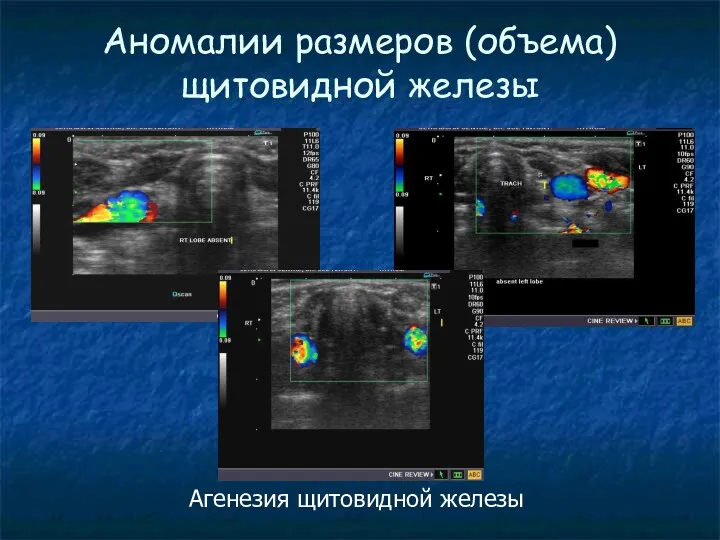 Аномалии размеров (объема) щитовидной железы Агенезия щитовидной железы