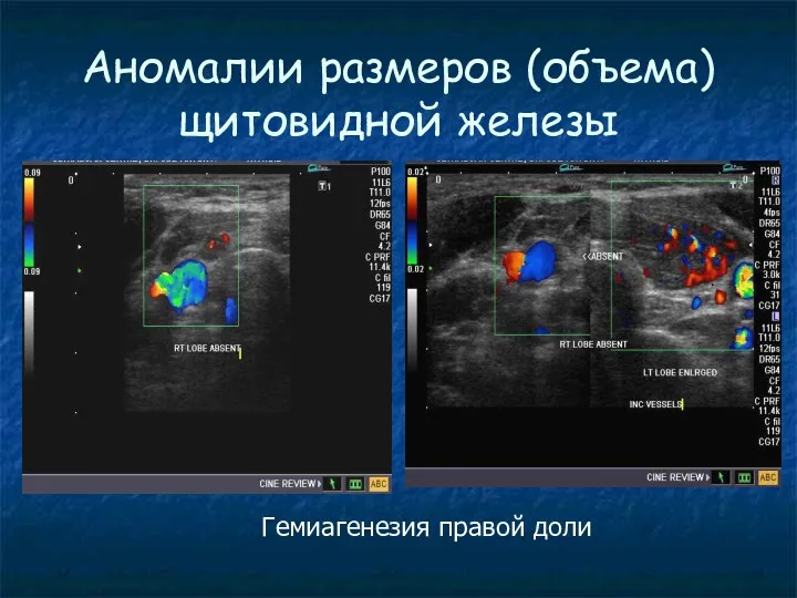 Аномалии размеров (объема) щитовидной железы Гемиагенезия правой доли