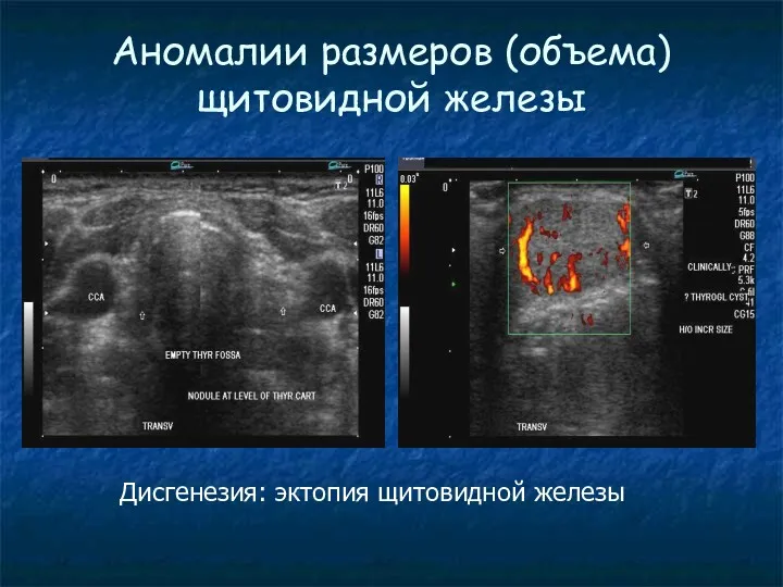 Аномалии размеров (объема) щитовидной железы Дисгенезия: эктопия щитовидной железы