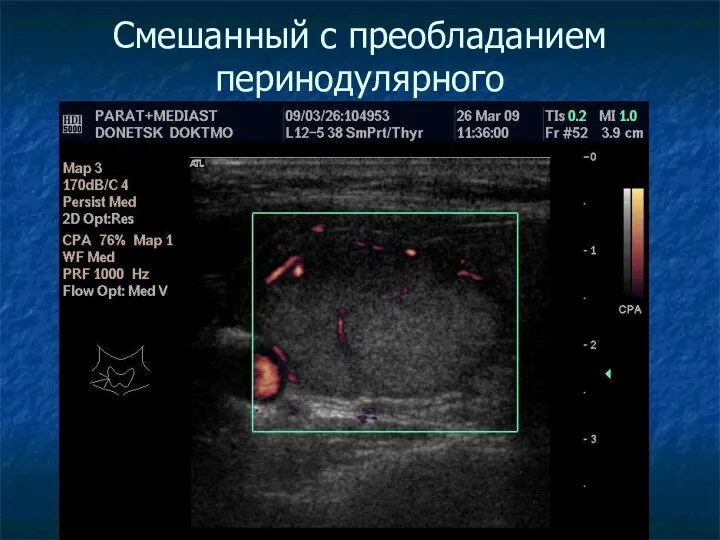 Смешанный с преобладанием перинодулярного