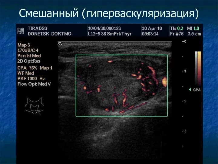 Смешанный (гиперваскуляризация)