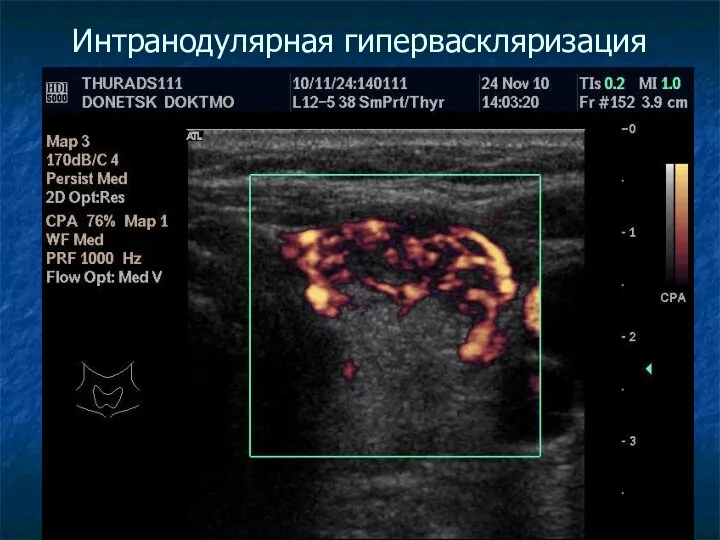 Интранодулярная гиперваскляризация