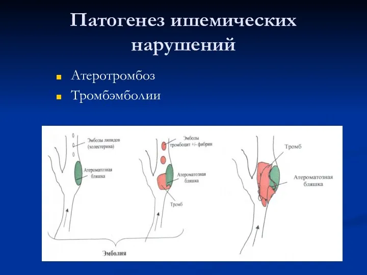 Патогенез ишемических нарушений Атеротромбоз Тромбэмболии