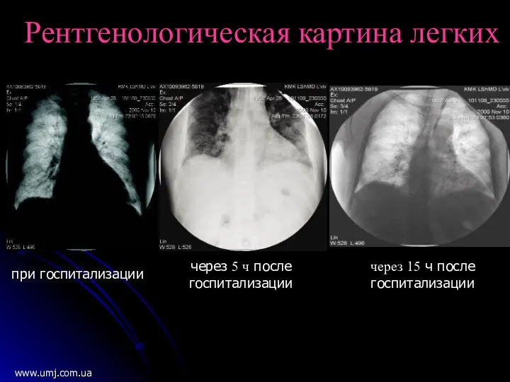 при госпитализации через 5 ч после госпитализации через 15 ч после госпитализации www.umj.com.ua Рентгенологическая картина легких