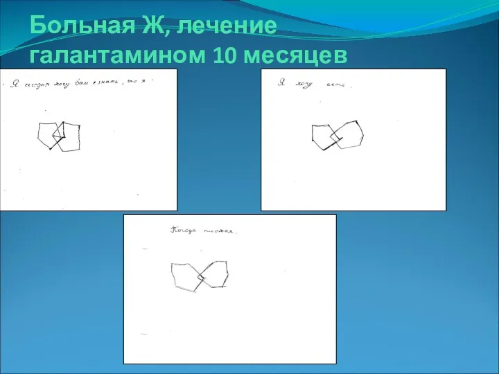 Больная Ж, лечение галантамином 10 месяцев