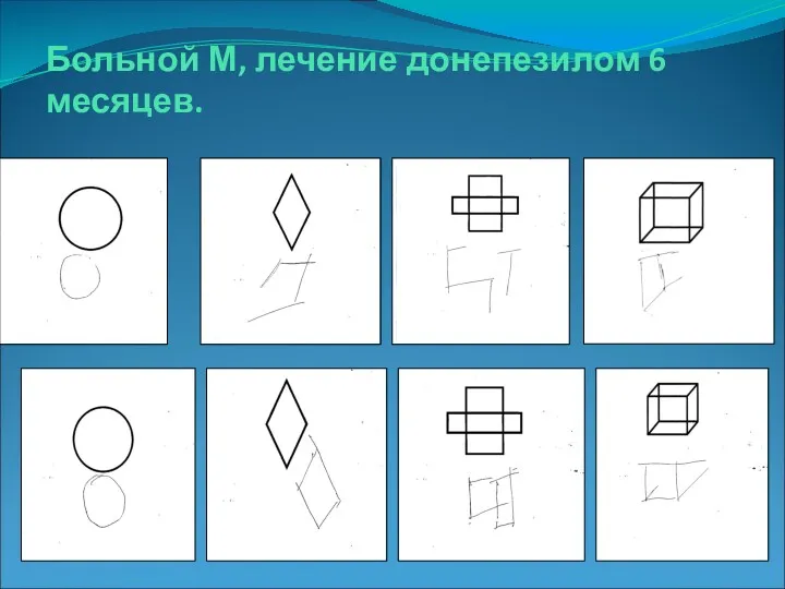 Больной М, лечение донепезилом 6 месяцев.