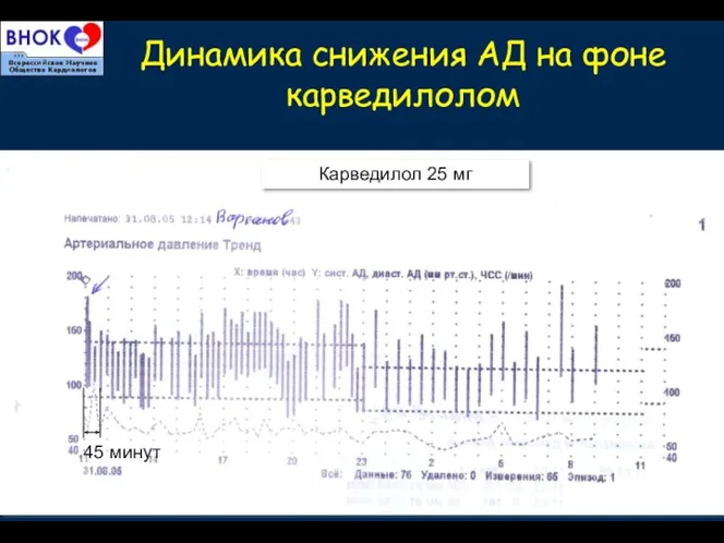 Динамика снижения АД на фоне карведилолом 45 минут Карведилол 25 мг