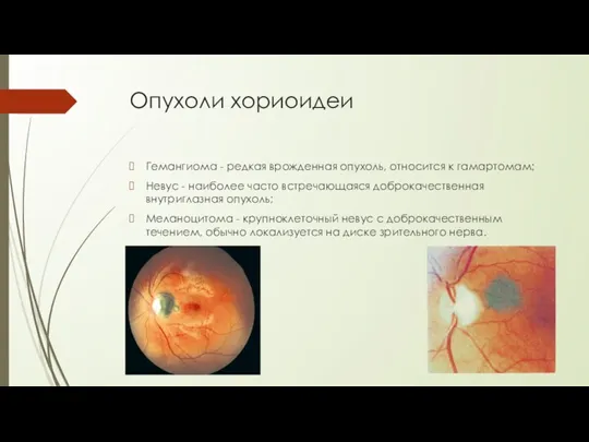 Опухоли хориоидеи Гемангиома - редкая врожденная опухоль, относится к гамартомам;