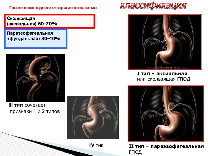 классификация Скользящая (аксиальная) 60-70% Параэзофагеальная (фундальная) 30-40% Грыжи пищеводного отверстия