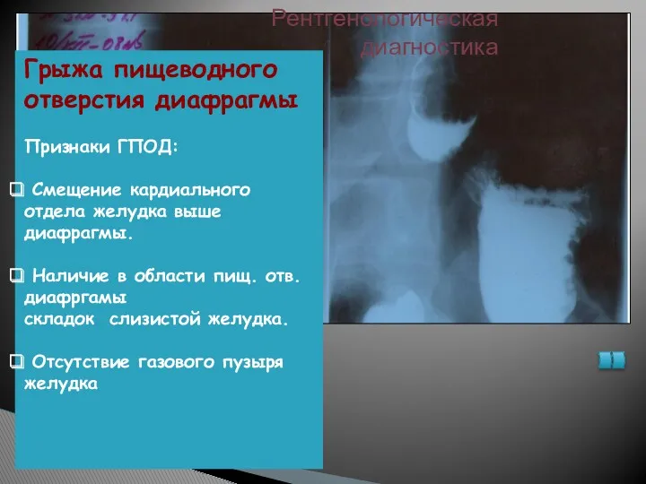 Рентгенологическая диагностика Грыжа пищеводного отверстия диафрагмы Признаки ГПОД: Смещение кардиального