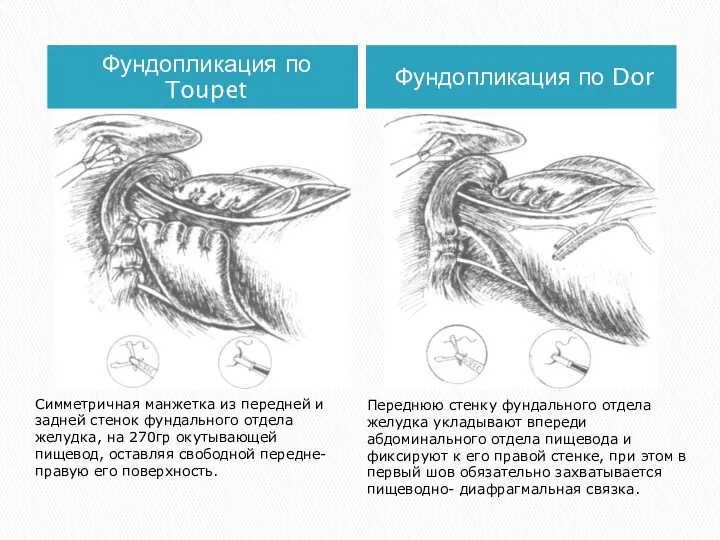 Фундопликация по Toupet Фундопликация по Dor Симметричная манжетка из передней