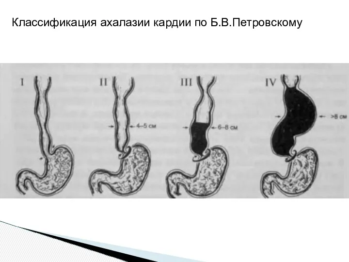 Классификация ахалазии кардии по Б.В.Петровскому
