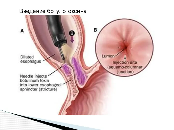 Введение ботулотоксина